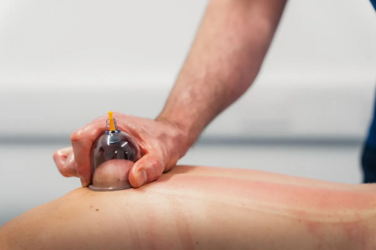 Cupping therapy treatment at Ascension