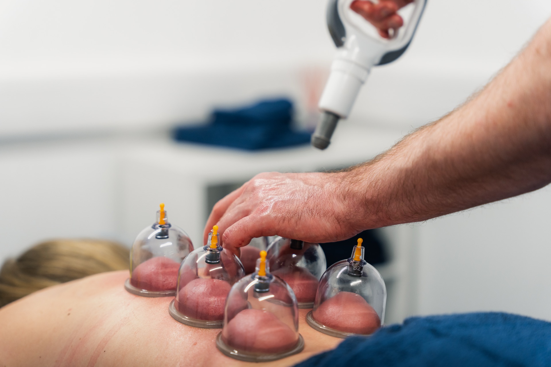 Myofascial cupping treatment at Ascension Physiotherapy & Performance